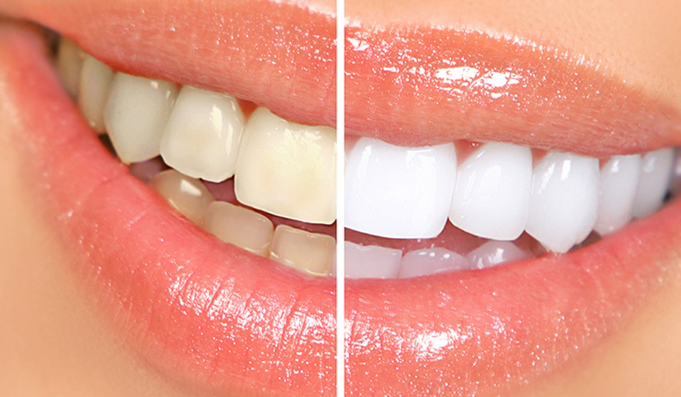 What Are Those Things In the Dentist’s Office